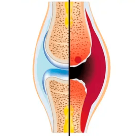 La struttura di un'articolazione sana e usurata chiamata tessuto cartilagineo e liquido sinoviale